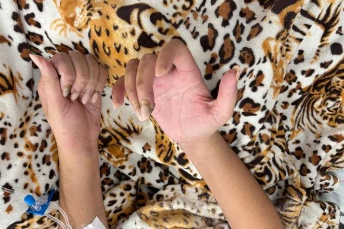 Unhas em gel levam jovem a quadro raro e grave de infecção cardíaca em Alagoas