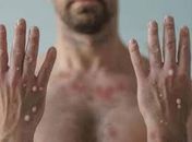 A mpox, antes conhecida como varíola dos macacos, é uma doença viral que pode ser transmitida entre humanos e animais.