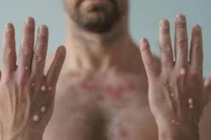 A mpox, antes conhecida como varíola dos macacos, é uma doença viral que pode ser transmitida entre humanos e animais.