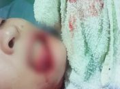 Jovem de 22 anos tem parte dos lábios arrancada em agressão e família cobra justiça em Viçosa