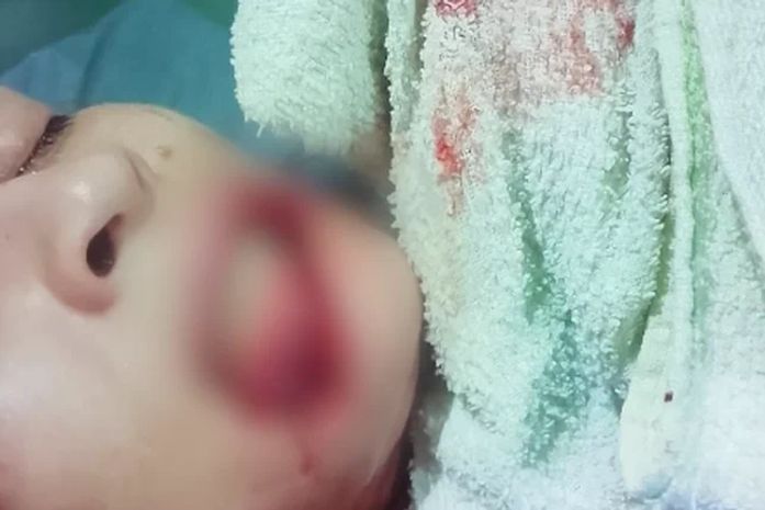 Jovem de 22 anos tem parte dos lábios arrancada em agressão e família cobra justiça em Viçosa