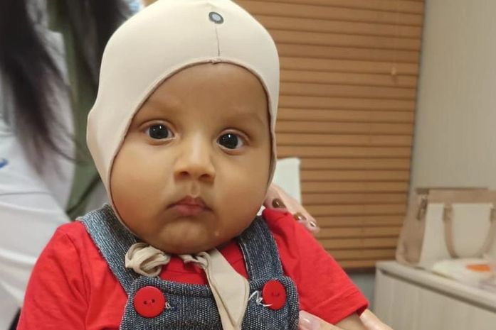 Pais de bebê com assemetria craniana lançam campanha para custear tratamento urgente
