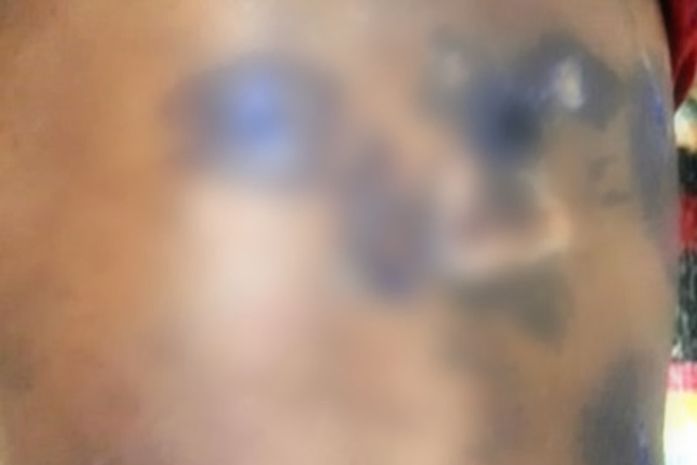 Criança de 5 anos é agredida e queimada pelo padrasto no Sertão de Alagoas; homem foi preso