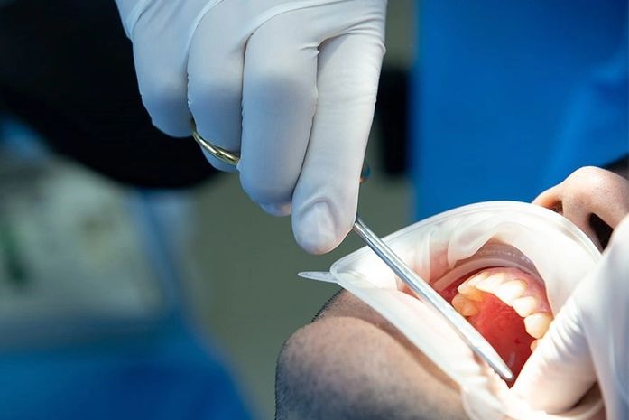 Descubra as principais causas de perda de dentes na população adulta