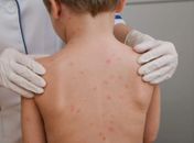 Alagoas lidera incidência de meningite no Nordeste e ocupa segunda posição no país
