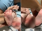 Bebê de sete meses fica ferido após ser queimado durante banho em berçário