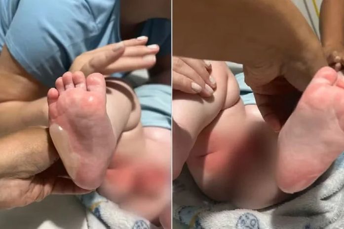 Bebê de sete meses fica ferido após ser queimado durante banho em berçário