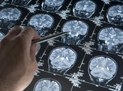 Estudo aponta relação entre 5 profissões e demência; saiba quais