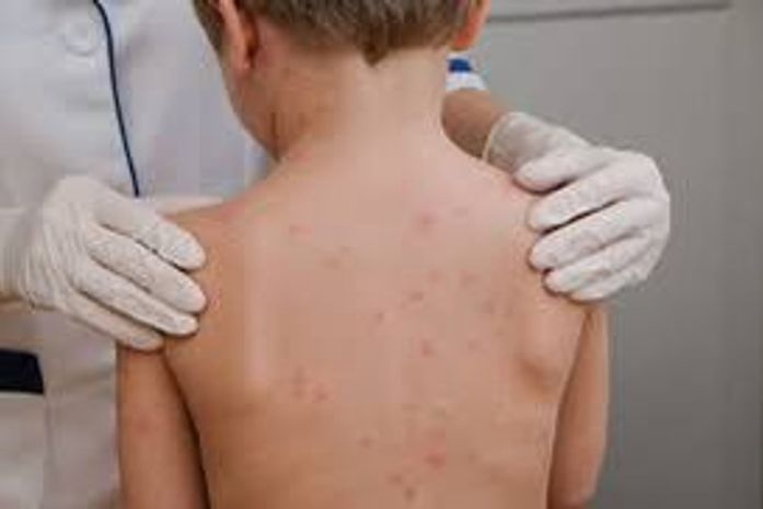 Prefeitura tranquiliza pais e mães de que não há casos de meningite no município