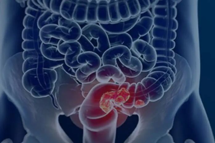 Estudo projeta aumento de 36% em mortes por câncer colorretal até 2040