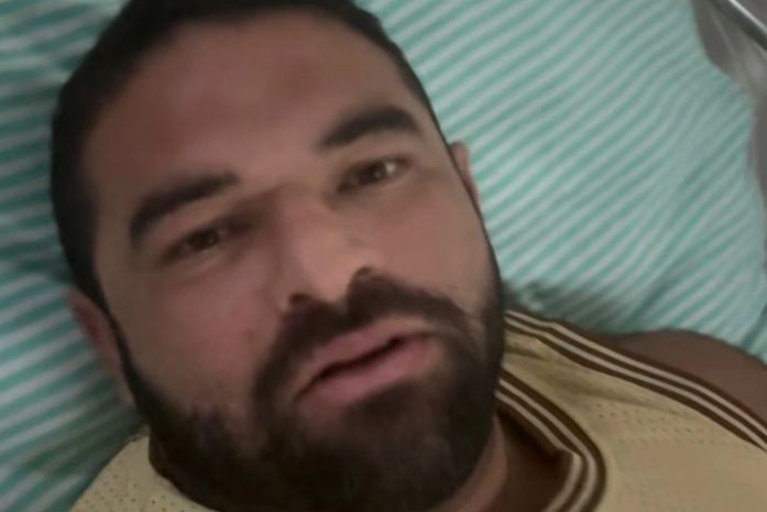 Aluno de academia relata acidente após aparelho quebrar: 'impacto de 100kg caindo sobre a costela'