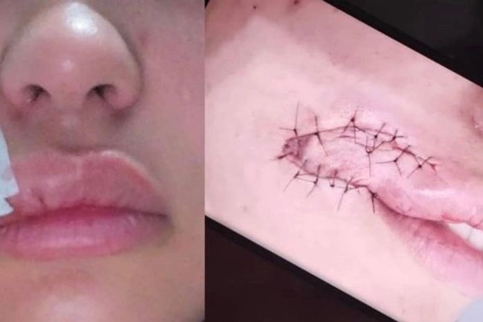 Mulher teve pedaço do rosto arrancada por mordida de criminoso durante assalto