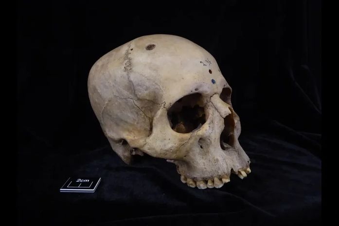 Crânio cortado sugere que os egípcios tentaram tratar o câncer há 4.000 anos