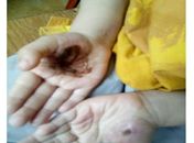 Crianças apresentavam queimaduras nas mãos e nos pés