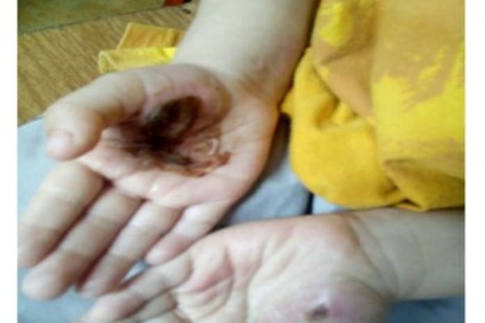 Crianças apresentavam queimaduras nas mãos e nos pés