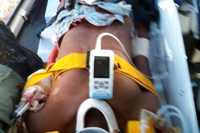 Adolescente tem braço amputado após acidente em Porto Calvo