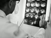 AVC mantém alta gravidade no Brasil e exige resposta imediata das equipes de saúde