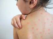 Arapiraca inicia 2a etapa da campanha de vacinação contra o sarampo nesta segunda (18)