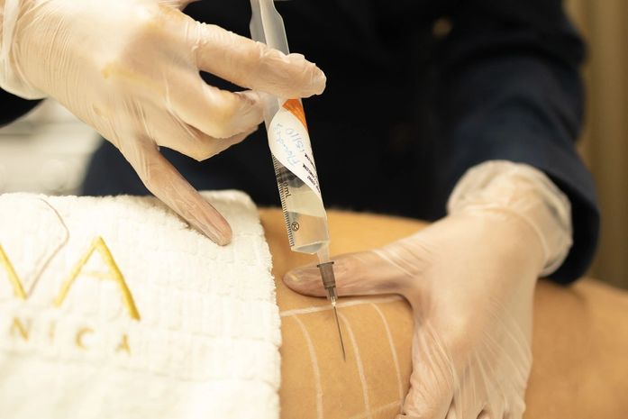 Conheça 4 benefícios da mesoterapia