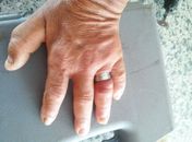 Casos de anel preso ao dedo tem aumentado em Maceió
