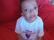 Família luta para arrecadar fundos para cirurgia de criança com craniossinostose