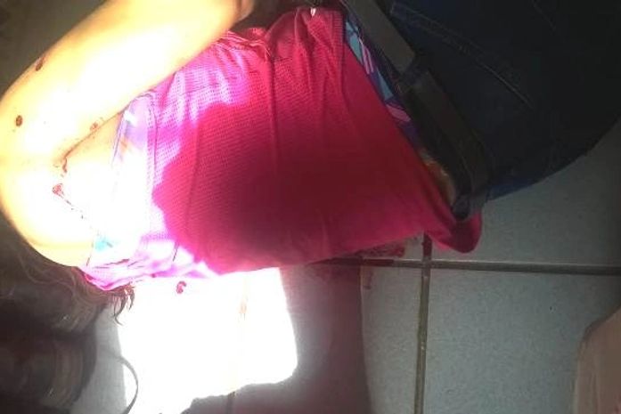 Mulher foi atingida nos braços e pernas