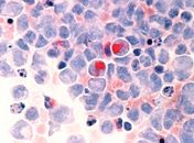 SUS estuda adoção de tratamento promissor contra câncer