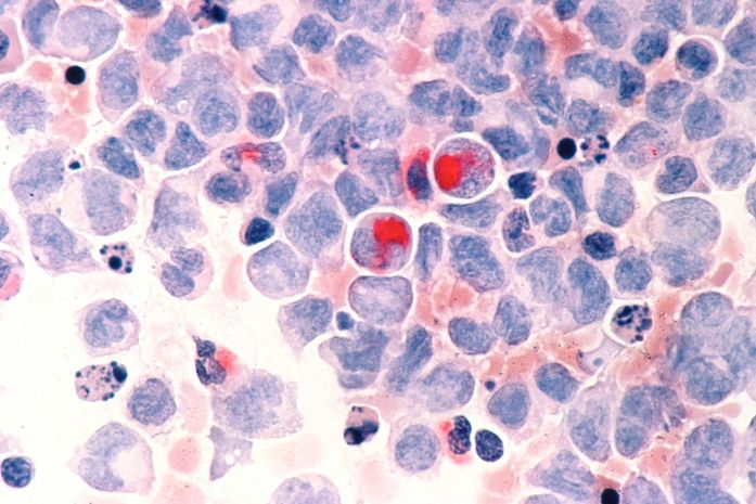 SUS estuda adoção de tratamento promissor contra câncer