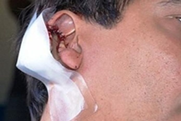 Paulo Corintho teve parte da orelha arrancada
