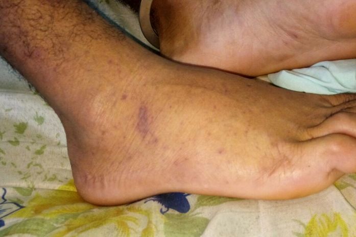 Pé de paciente mostra um dos sintomas característicos da doença