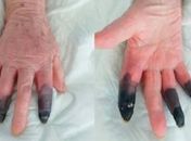 Idosa de 86 anos tem reação rara e teve que amputar três dedos
