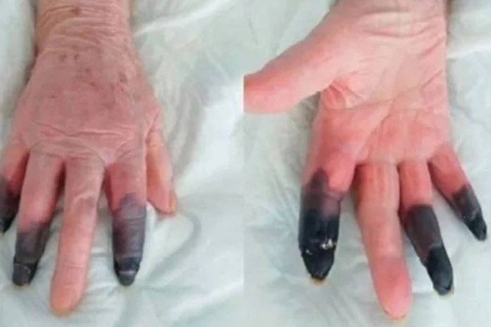 Idosa de 86 anos tem reação rara e teve que amputar três dedos