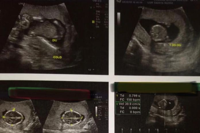 Coren Alagoas afirma que implantação de DIU por enfermeiro foi feito dentro das normas