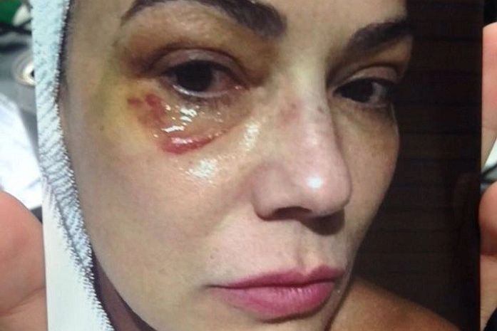 Luíza Brunet com marca de agressão doméstica