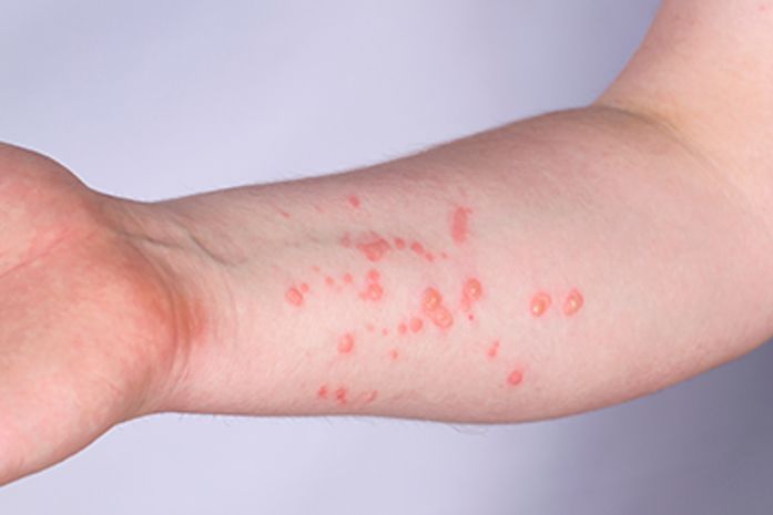 Varíola dos Macacos