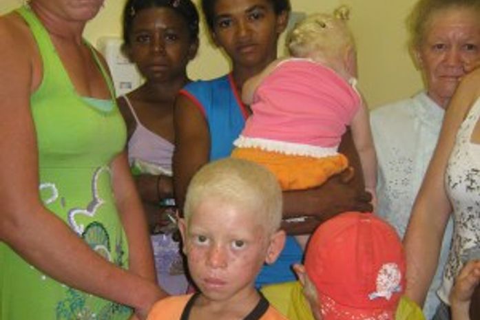 Precisamos falar sobre portador@s de albinismo, em Alagoas.