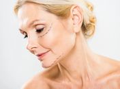 Rejuvenescimento da face: quando os fios de PDO podem ajudar?