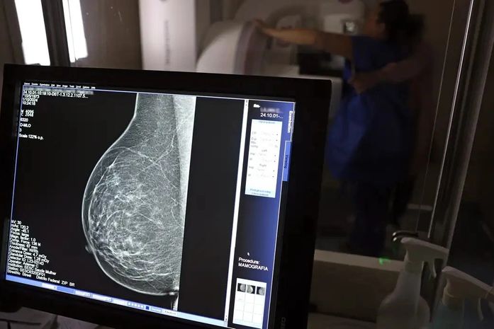 Periodicidade de mamografias divide médicos e autoridades de saúde