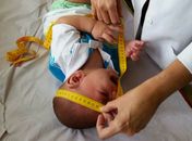 Bebê com microcefalia