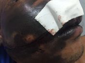 José Vânio sofreu queimaduras no rosto por conta da explosão do aparelho