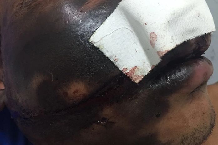 José Vânio sofreu queimaduras no rosto por conta da explosão do aparelho