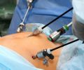 Menos de 1% dos brasileiros com indicação para bariátrica conseguem operar — e o plano de saúde pode ser um dos obstáculos

