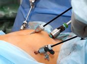 Menos de 1% dos brasileiros com indicação para bariátrica conseguem operar — e o plano de saúde pode ser um dos obstáculos

