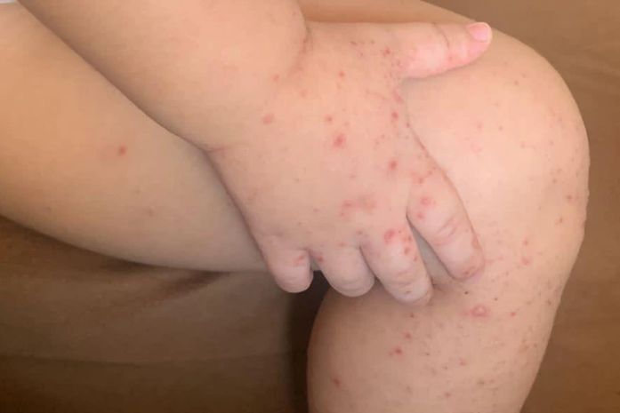 Falta de apetite, vômitos e diarreia: Infectologista orienta sobre os sintomas e formas de prevenção do Vírus Mão-Pé-Boca