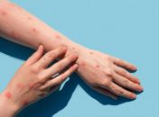 Varíola dos Macacos