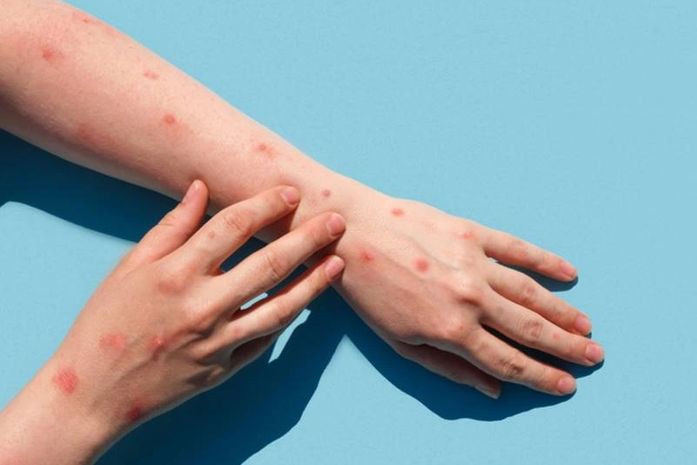 Varíola dos Macacos