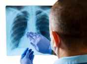 Unidades de Saúde realizam Dia D para identificar casos de tuberculose em Maceió