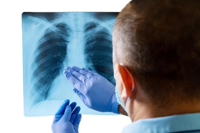 Unidades de Saúde realizam Dia D para identificar casos de tuberculose em Maceió