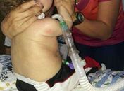 João Miguel tinha Atrofia Muscular Espinhal (AME), doença responsável pela perda dos neurônios motores.