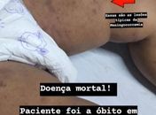 HGE confirma óbito de bebê por meningite; técnicos da Sesau acompanham o caso 